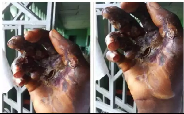 Boy Accused Of Stealing Laptop Gets His Hand Burnt During Failed ‘Spiritual Exercise’. Photos